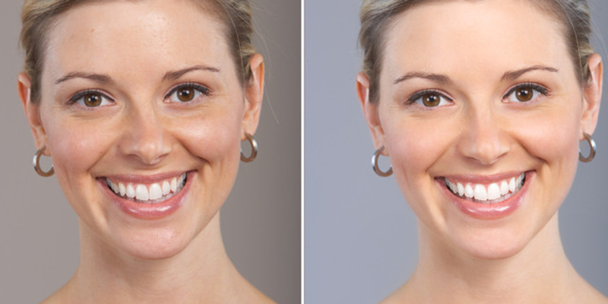 Skin Lightening Treatment in Delhi: Expert Solutions from Medlinks & Top Dermatologists in Gurgaon