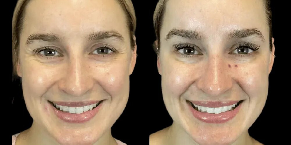 Combining Botox in Dubai with Other Skin Treatments for Best Results