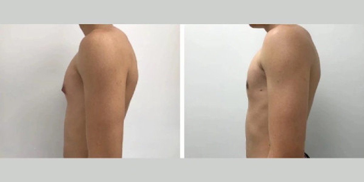 How to Talk to Your Partner About Gynecomastia Treatment in Dubai