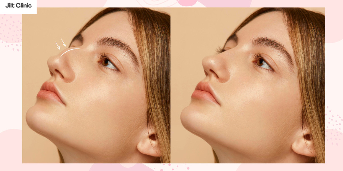 Die Kunst der ästhetischen Optimierung: Moderne Wege zur nasenkorrektur zürich