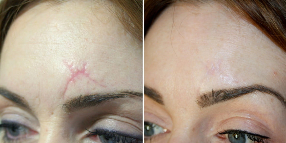 Say Goodbye to Stretch Marks: How Inkless Stretch Mark Serum Works