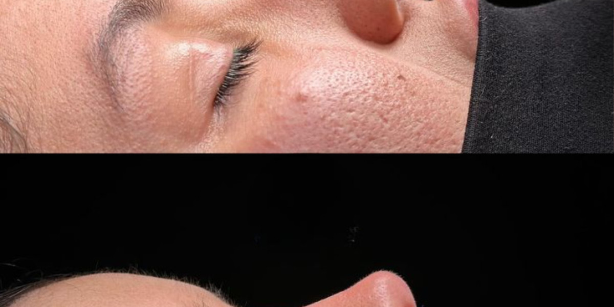 Get a Perfect Nose with Rhinoplasty in Islamabad