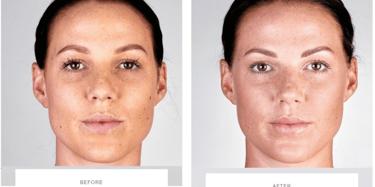 Laser Skin Resurfacing Orlando