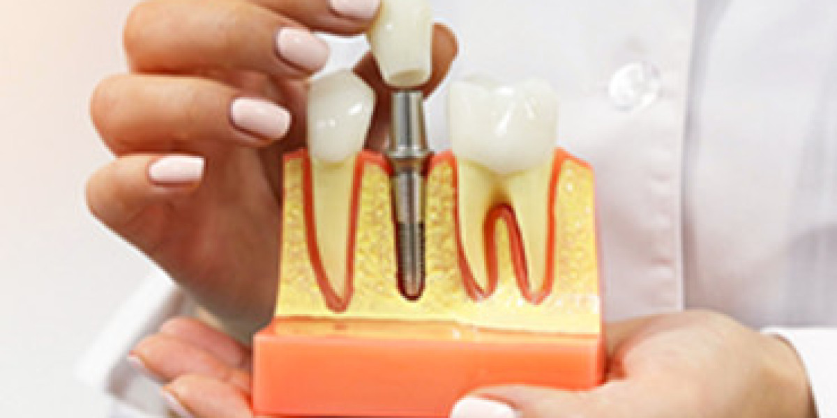 Full Mouth vs Single Dental Implants: Cost Comparison India vs Abroad