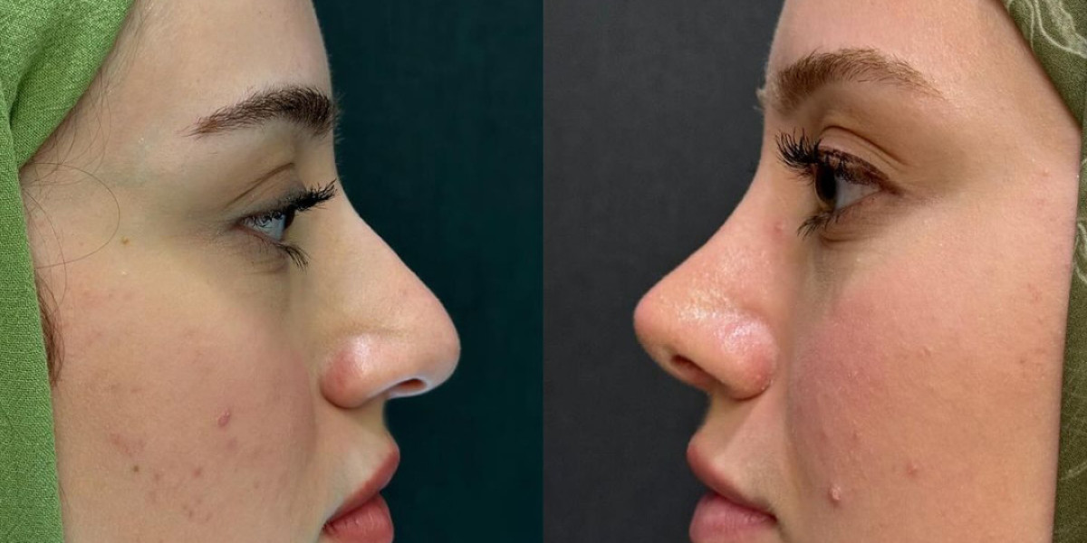 Rising Popularity of Rhinoplasty in Islamabad