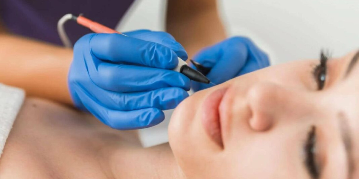 How to Prepare for Electrolysis Laser Hair Removal Treatment