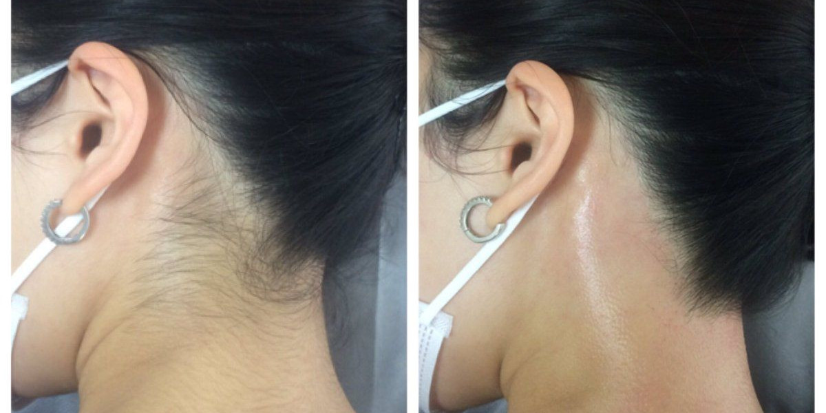 Permanent Hair Reduction with Laser Hair Removal