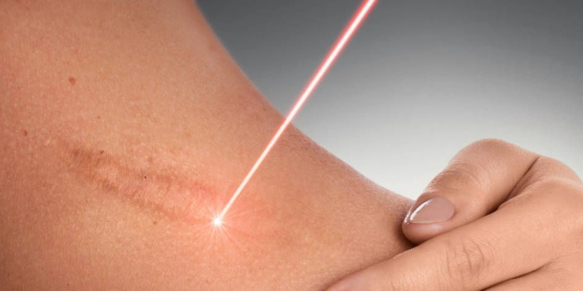 بشرتك تستعيد حيويتها مع إزالة الندبات بالليزر