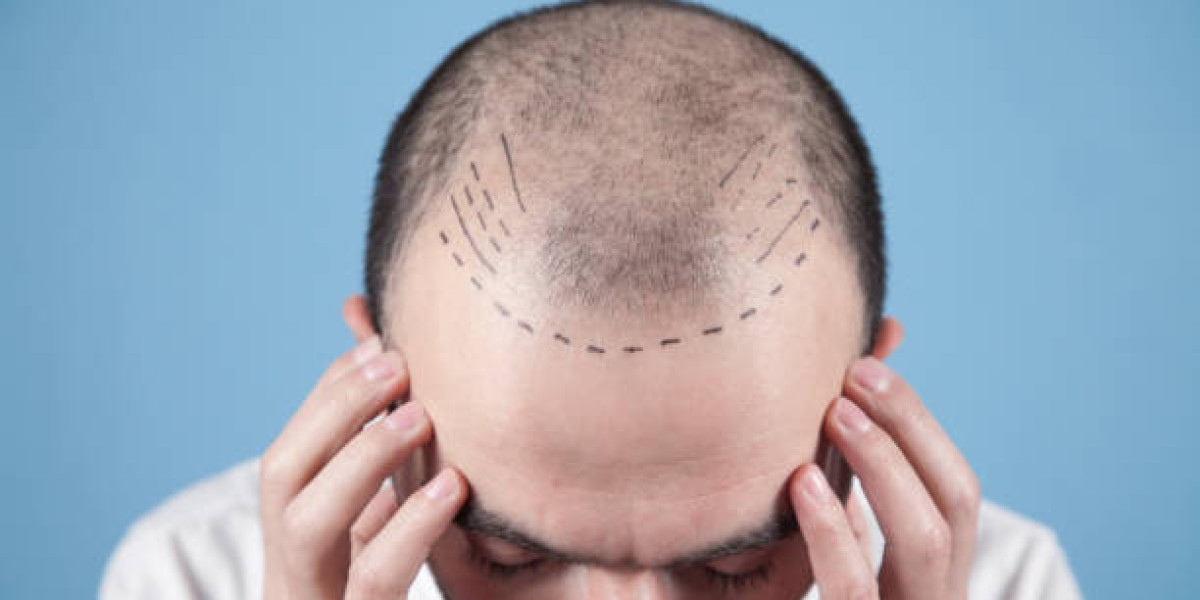 Swimming and Sun After Hair Transplant: Safe Guidelines
