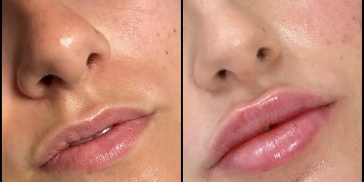 Best Doctors in Dubai for Fillers for Men and Women