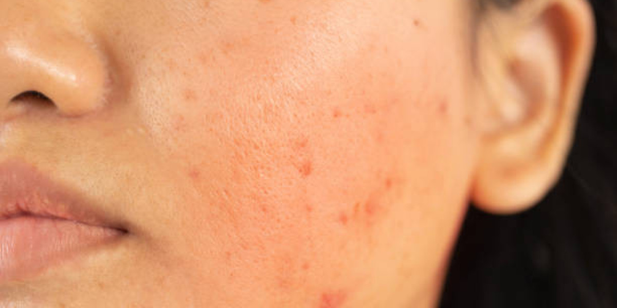 Laser Acne Treatment Before and After: Real Transformations for Troubled Skin