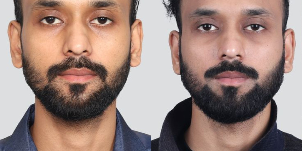 Hair Transplant in Islamabad: Restore Your Hair Naturally