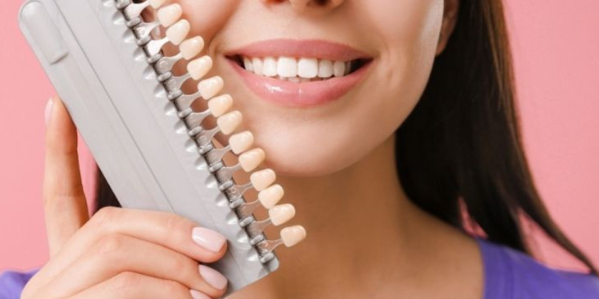 Dental Veneers Cost and Recovery Process Explained