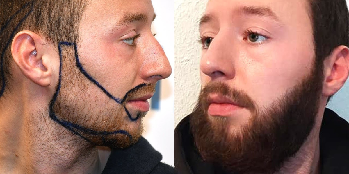 Beard Hair Transplant Gone Wrong: What to Know