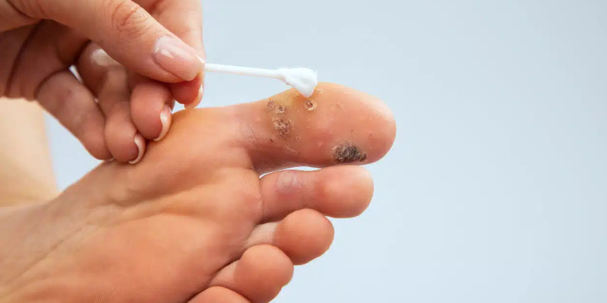 Skin Wart Removal Cost: Understanding Treatment Complexity