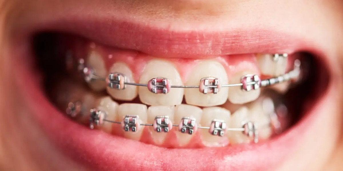 Dental Braces for Spacing and Gap Issues