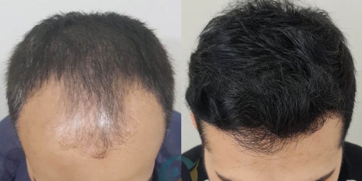 Top Reasons to Get a Hair Transplant in Islamabad This Year